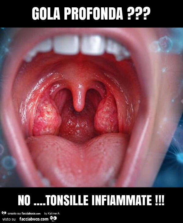 Gola profonda? No&hellip; tonsille infiammate